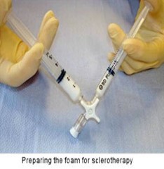 Varicose Vein Example 1